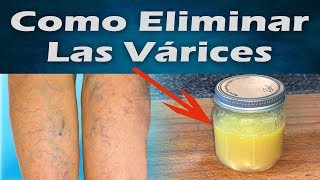 Varicosas las venas remedios para caseros ayurvédicos