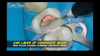 rewalling adalah pre endodontic build up to create 4 walled cavity access molar composite resin