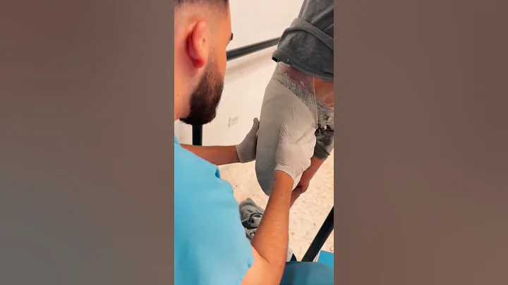 Casting Above Knee Amputees: Step-by-Step Prosthetic Fitting Process