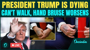 LIVE: Trump Dying Slowly? Hand Bruise and Stair Fumble Raise Concerns About 79 Year Trump