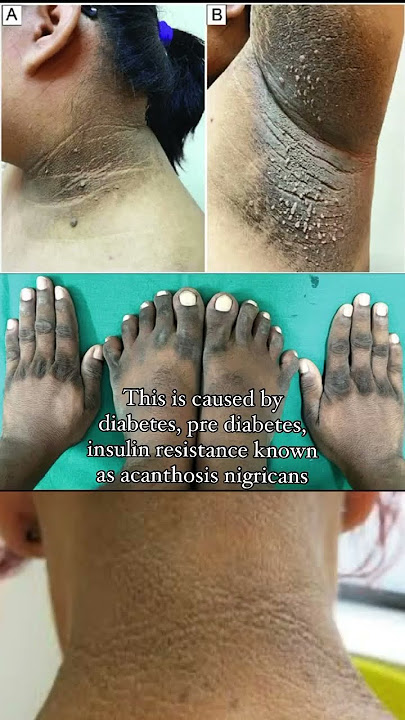 Download lagu This pigmentation is not SUN TAN! Hyperpigmentation on face dark spots black patch on face #skincare