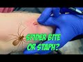 Spider Bite or Staph? NEW