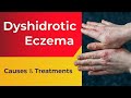 What is Dyshidrotic Eczema? - Overview, Causes, Treatments