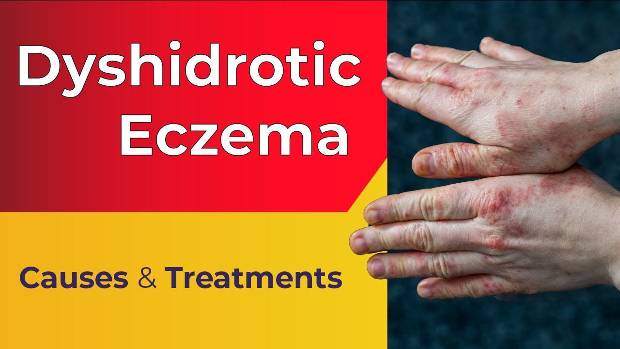 Dyshidrotic eczema: symptoms, causes, and treatment