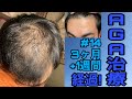 AGA治療3ヶ月+1週間経過！ちゃんと比較してみると効果が分かりますね！
