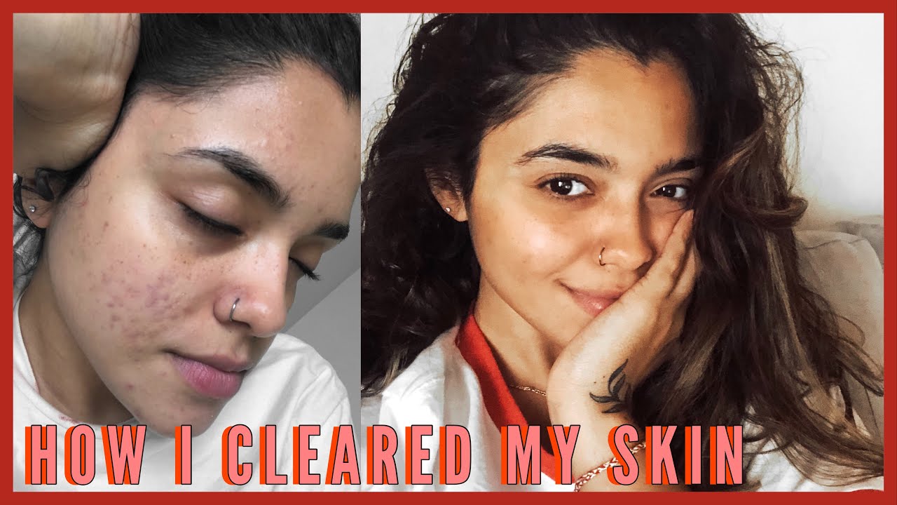 HOW I CLEARED MY SKIN - YouTube