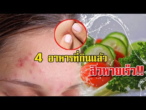 สิวไม่ชอบ!! 4 อาหารที่กินแล้ว "สิวหายเร็ว" โดนใจหนุ่มสาว ใครที่เป็นอยู่รีบมาทานด่วน !!