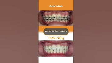 Hành trình LỘT XÁC nhờ niềng răng của Nguyệt Nhi