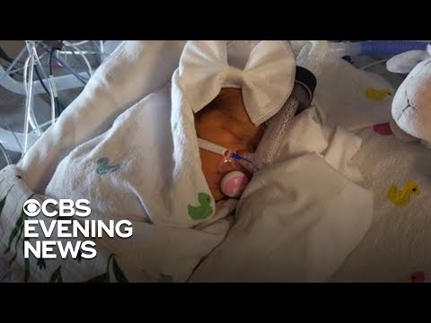 Baby born after undergoing experimental surgery in the womb