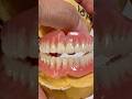 Upper and lower dentures that we just completed in my lab for Dr. James Kim of Wisconsin