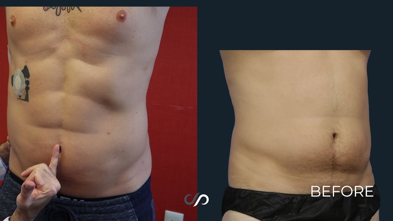 Male Body Sculpting | Los Angeles, CA | Dr. David Stoker