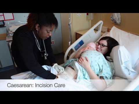 Video: Bandage And Caesarean Section