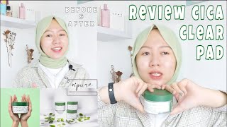 Review: Natural & Mild Exfo with N'PURE CICA CLEAR PAD + BEFORE-AFTER | Satya Irada