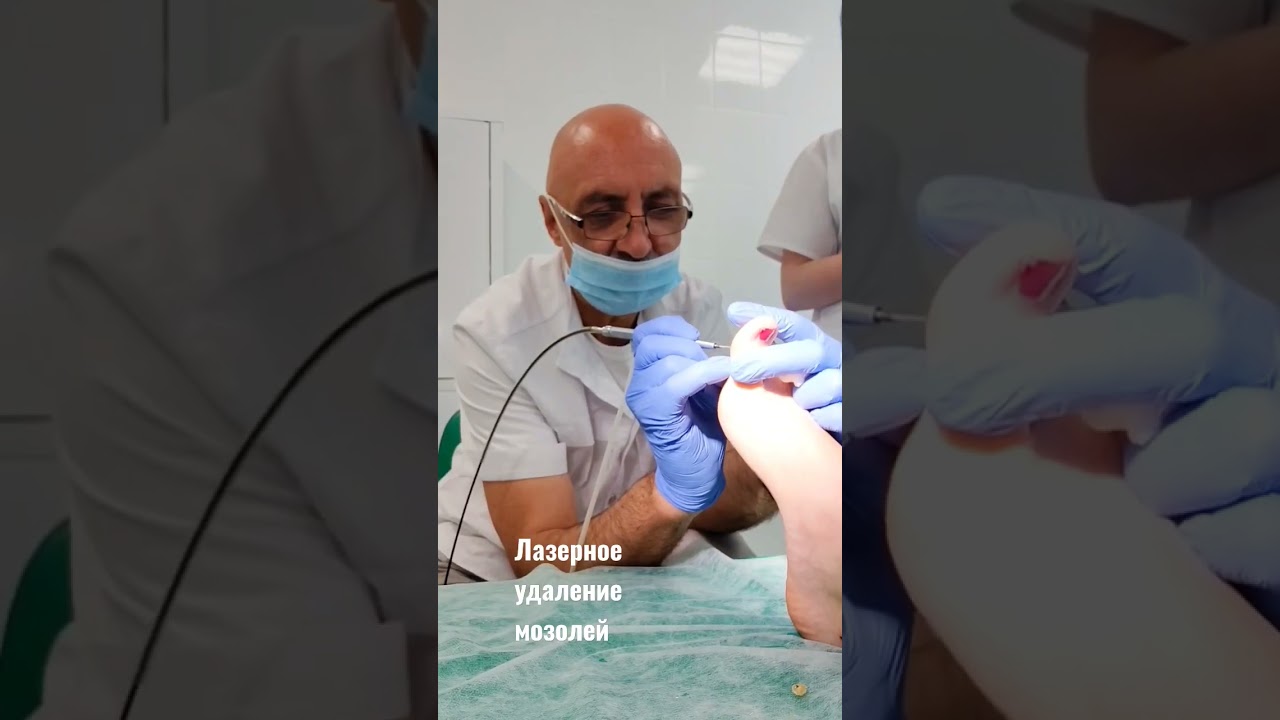 Удаление мозолей лазером💥 Процедура проводится быстро и безболезненно