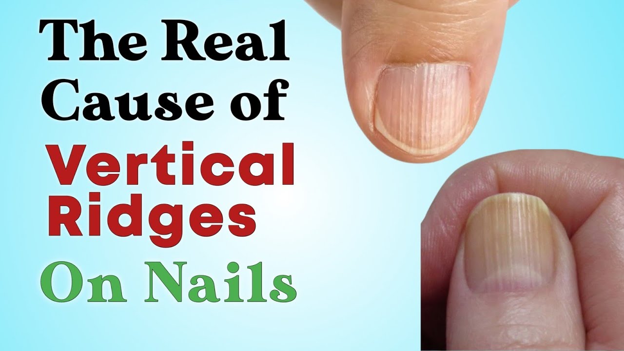 What Those Vertical Ridges On Your Nails Say About Your Health-2023-TechFit  with Meer - video Dailymotion