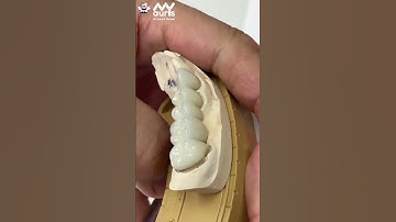 CẦU RĂNG SỨ 5 CHIẾC