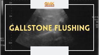 Gallstone Flushing (PART 2) | Usapang Pangkalusugan