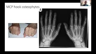 Genetic Haemochromatosis : Joint pain and arthropathy with Professor Patrick Kiely