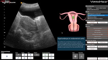 ASRM Embryo Transfer Simulator