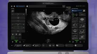 GE Voluson™ Club   Learning Library   Voluson SWIFT GYN Tools Tech Tips 2021