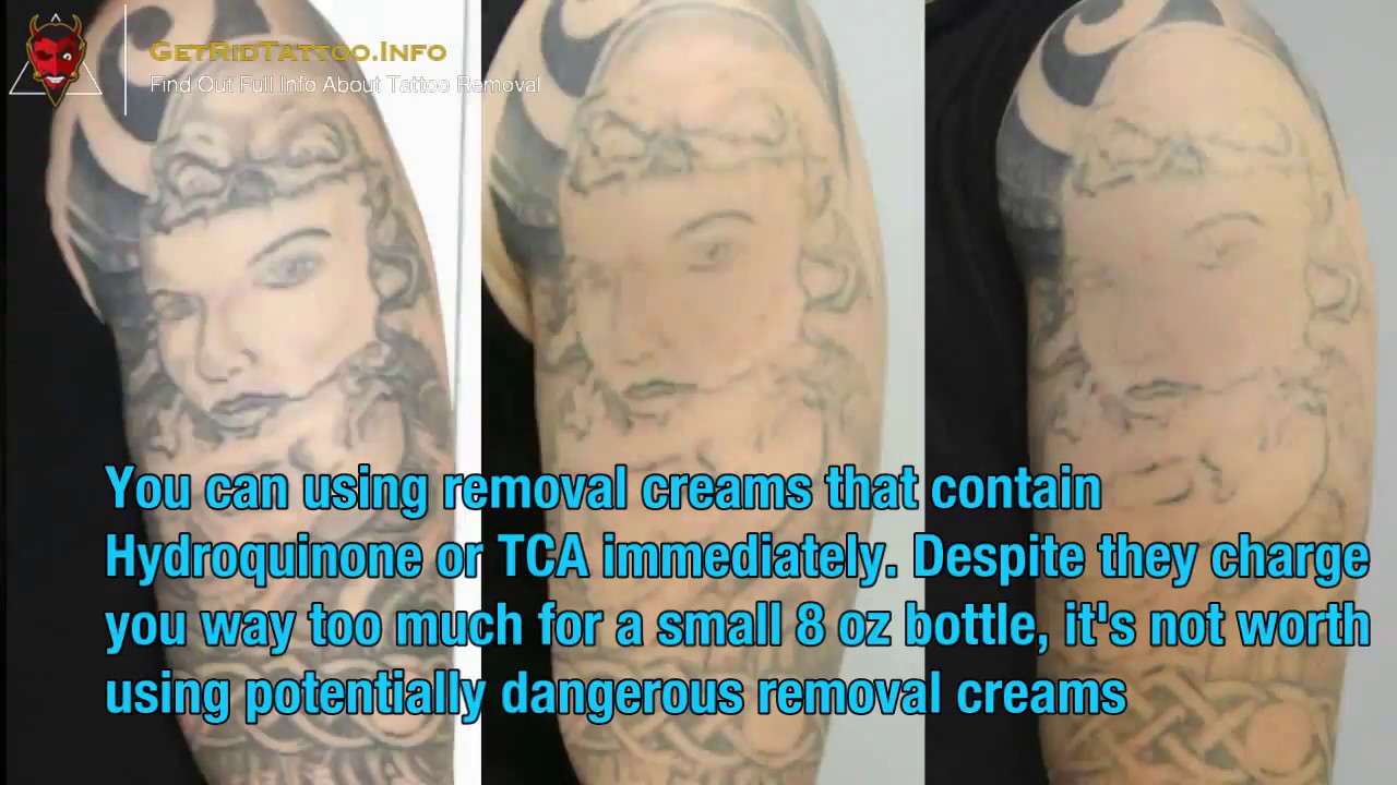 Lasering Tattoos Off Everything You Must To Know About Tattoo Remove Youtube