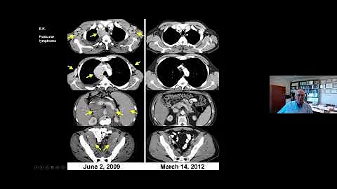 Providence Cancer Institute Oncology Grand Rounds 4/22/22 – Prof. Steven A. Rosenberg, M.D., Ph.D.