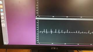 RPM Sensor Using the Hall Effect: Digital Signal Processing 4 IIR Filter Assignment