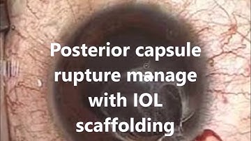 one minute video of posterior capsule rupture and IOL scaffolding