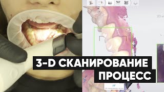 Внутриротовое 3D сканирование 3shape Trios 3 процесс | Sergatiy Dental Clinic