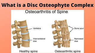 What is a Disc Osteophyte Complex