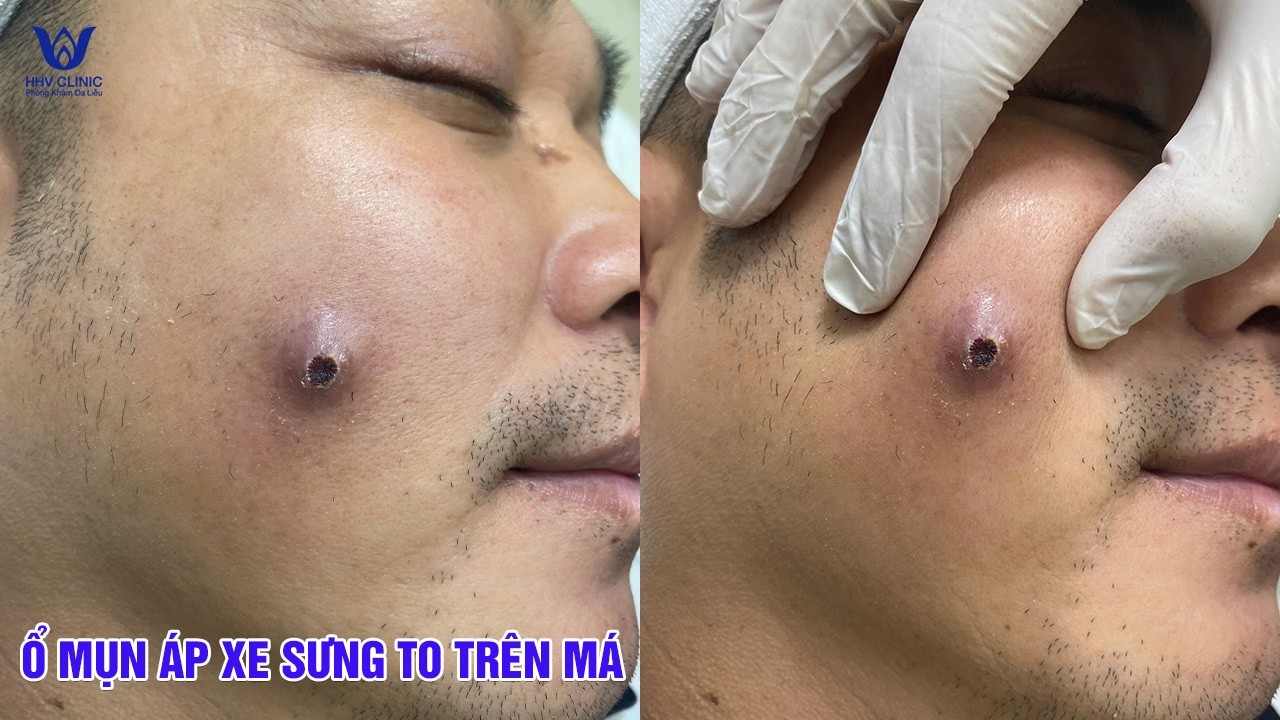 Mụn U Nang Viêm Nặng Trên Má Chứa Ổ Mủ Lớn Xử Lý Sai Có Thể Để Lại Sẹo.