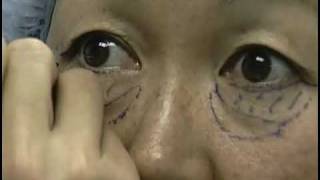 Dr. Peter Newen - CBS News Feature on Upper & Lower Eyelid Surgery