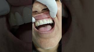 zirconia dental bridge is a highly durable, metal-free restoration used to replace one #zirconia