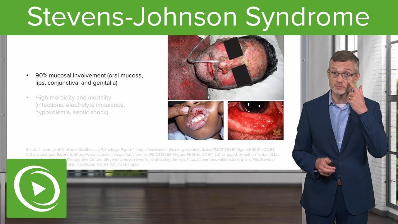 Stevens-Johnson Syndrome – Dermatology | Lecturio