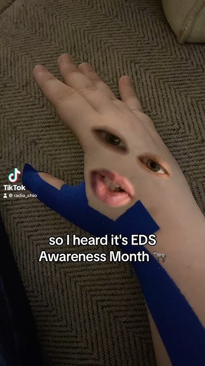 EDS awareness month 🦓 #heds #ehlersdanlos #health - YouTube