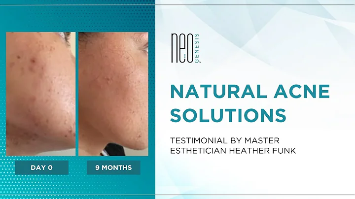 Natural Acne Solutions: Testimonial by Master Esth...