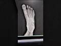 CR X-RAY Foot AP View