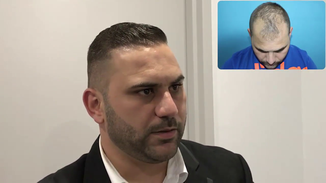Hair Transplant Results Eugenix Hair Transplant Sciences YouTube