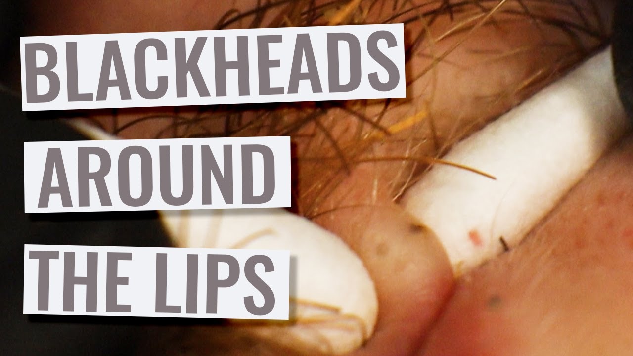 Gebhard The Q Tips Deep Blackheads Around The Lips