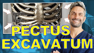 Surgery for Pectus Excavatum - The Magic of Connected Bars
