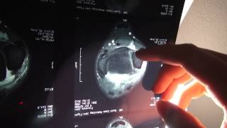 #TOURNOTES: JOHN JOHN FLORENCE'S ANKLE INJURY