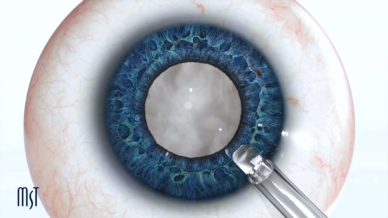 Huba Kiss - Ophthalmic Surgeon - Optical Express | LinkedIn