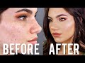 Cover ACNE with DRUGSTORE Makeup & Brushes! FULL COVERAGE Foundation