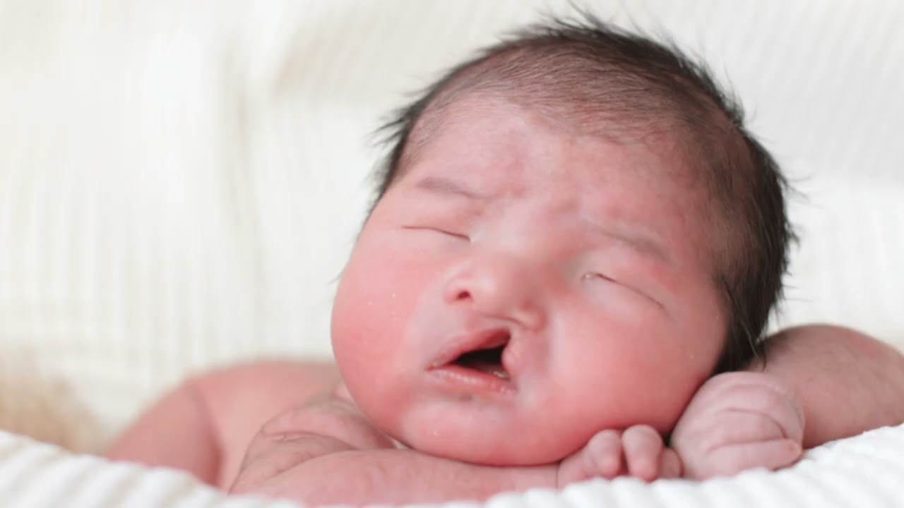 जाने Cleft lip बीमारी क्या होती और ये बीमारी किन में पाई जाती है