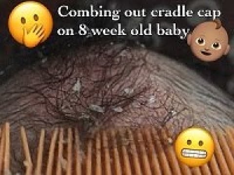 Video 8 Week Old Baby Cradle Cap