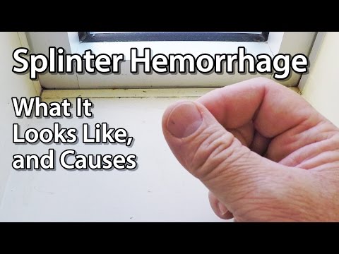 Splinter Hemorrhage - What It Looks Like, and Causes