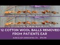 12 COTTON WOOL BALLS REMOVED FROM PATIENTS EARS - EP178