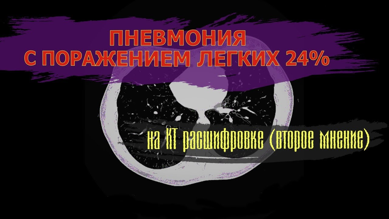 Двусторонняя полисегментарная ПНЕВМОНИЯ (поражение 24%) и КИСТА левой ...