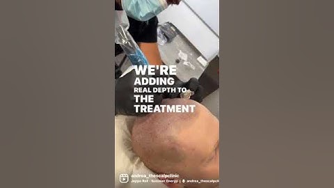 Scalp Micropigmentation For Male Pattern Baldness | Adding 3D Depth | The Scalp Clinic