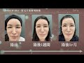 眉下切開(眉毛下皮膚切除)の第1人者による手術- 林寛子ジョイアクリニック 京都 烏丸御池  形成外科・美容皮膚科・再生医療